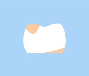カリエスチェック