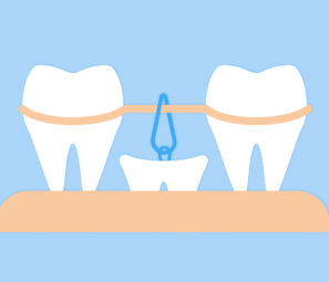 エクストルージョン(歯根挺出術)