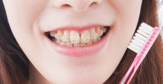 矯正中の歯磨き