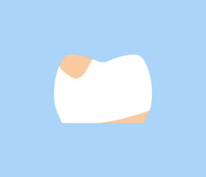 カリエスチェック